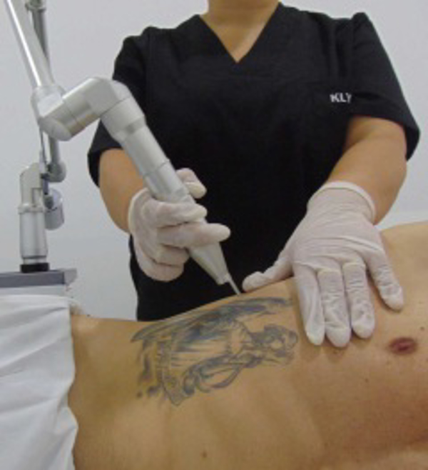 Centro klynInk contará con la Última tecnología Láser