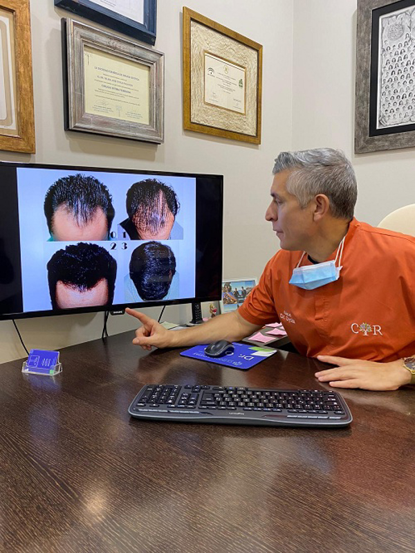 Las franquicias Clínicas Revitae oferta implante capilar de alta durabilidad