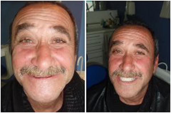 La ONG APES y la franquicia Dental Company devuelven la sonrisa a Tony